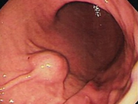 【画像】胃粘膜下腫瘍