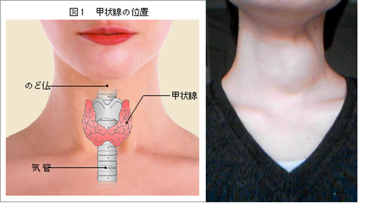 副甲状腺機能亢進症の人の腰痛の原因は何ですか?