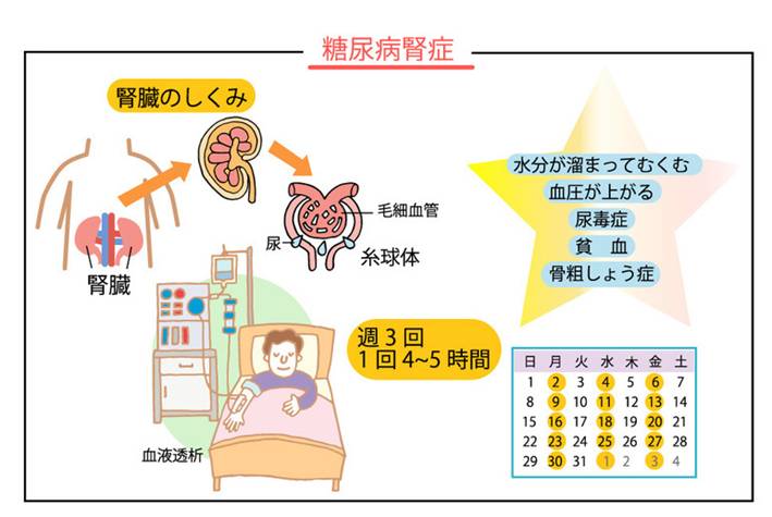 糖尿病腎症の基礎知識――透析になる可能性 | メディカルノート