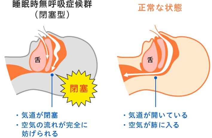 睡眠時無呼吸症候群(SAS)ってどんな病気? | 睡眠医療・介護事業のメディカルケア