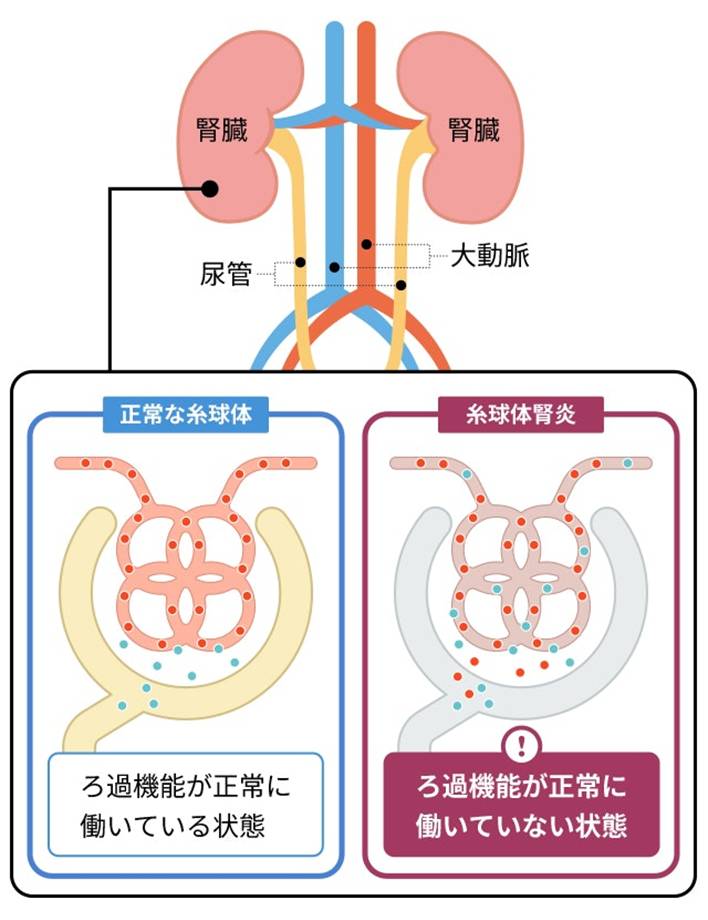 糸球体腎炎」とはどのような病気ですか? |糸球体腎炎