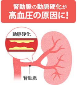 腎動脈の動脈硬化による高血圧に注意!|オムロン ヘルスケア
